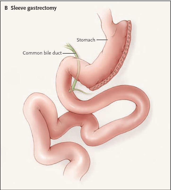 Bariatric Surgery: Weight Change Sleeve Gastrectomy Years Bariatric Surgery and Mortality Swedish Obese Subjects Study 4047 subjects, surgery