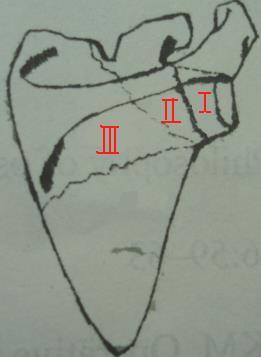 Classification of the scapular neck fracture Type I : anatomical neck fracture