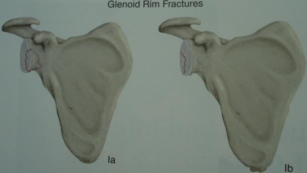 border of glenoid fracture