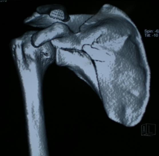 fossa fracture and