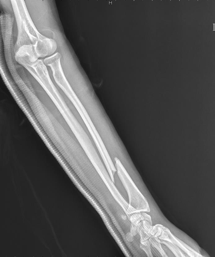 fracture of