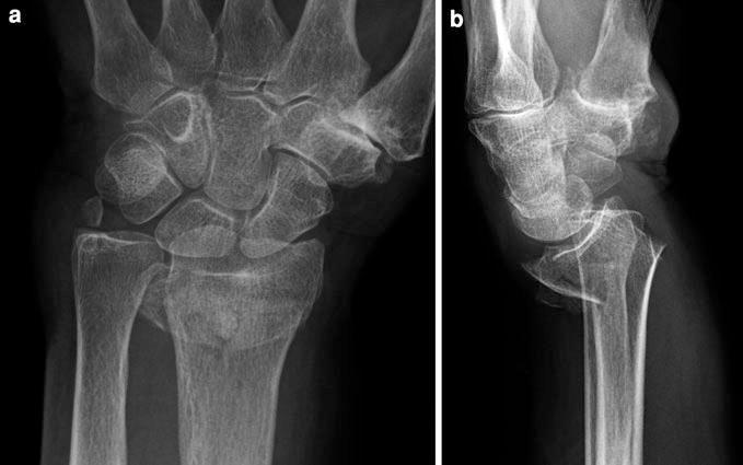 Distal radial fracture Colles fracture.