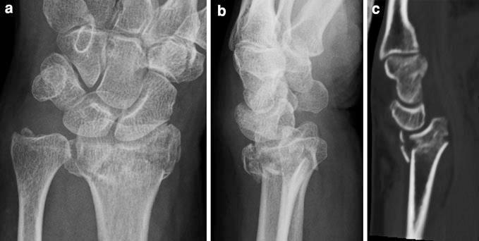 Barton fracture: A: There is a fracture of the distal radius with extension into the radial