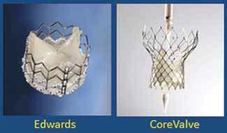 TAVI FIGURE 1. The two commercially available prosthetic valves: CoreValve (Medtronic, Inc.) 