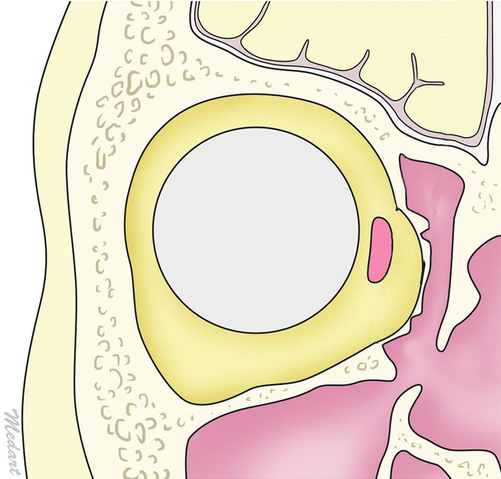 Vol. 40 / No. 6 / November 2013 cyst formation [2]. Al-Sukhun et al. [3] reported that absorbable implants are reliable for large ( > 2 cm 2 ) inferior orbital wall bony defects.