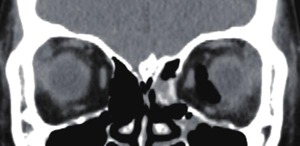 Vol. 40 / No. 6 / November 2013 Fig. 3. Case 1, medial orbital wall reconstruction (A) Preoperative computed tomography (CT) showed a medial orbital wall fracture on the left side.