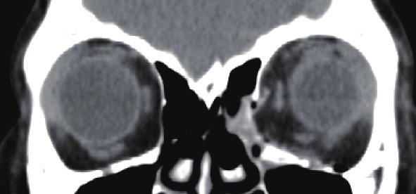 (C) Postoperative CT at the 2-year follow-up showed a well healed medial orbital wall, but both orbits showed asymmetry.