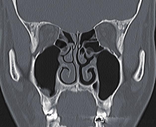 Vol. 40 / No. 6 / November 2013 Fig. 6. The bony buttress on coronal view The bony buttress is identical to the superior medial wall of maxillary sinus.
