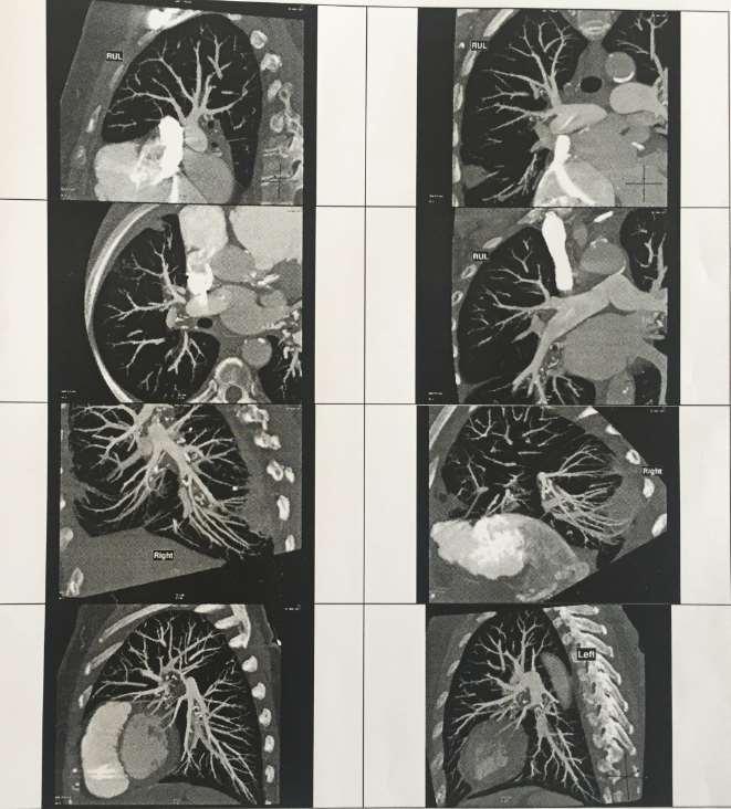 CT thorax