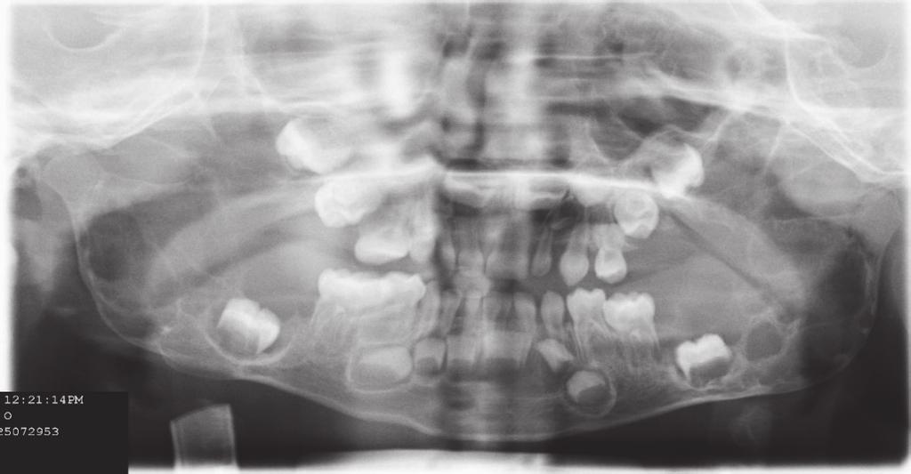The lesion is bilateral and often involves both jaws. Mandible is the most common location, when only one jaw is involved.