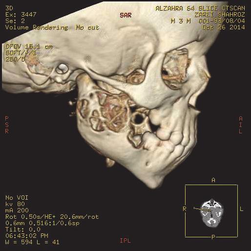 lesion in maxilla