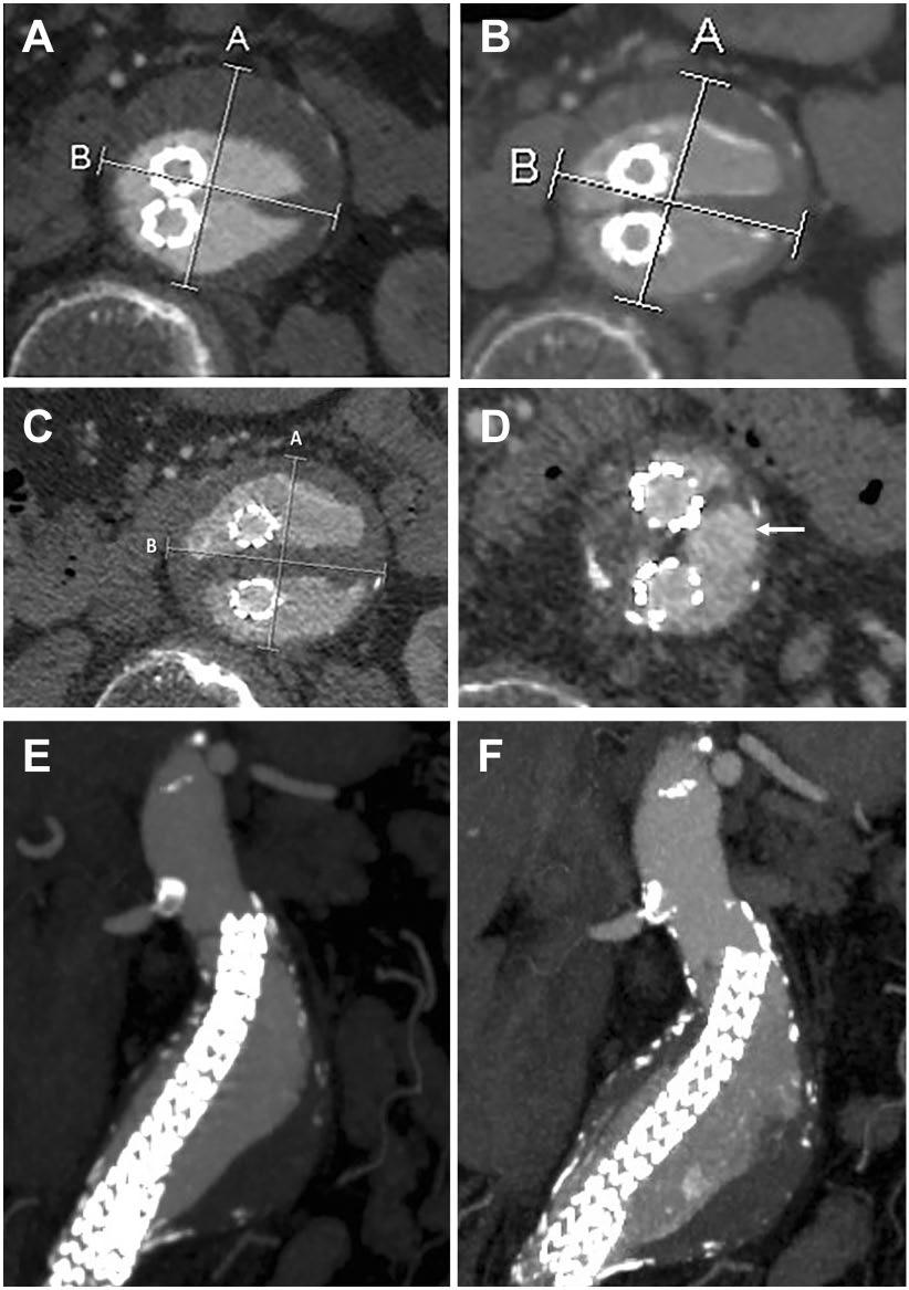 Donselaar et al 215 Figure 5. Images from an 85-year-old woman originally treated with endovascular aneurysm sealing (EVAS) outside the instructions for use due to a conical neck with some thrombus.