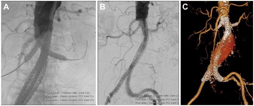 216 Journal of Endovascular Therapy 24(2) Figure 6. (A) Angiography after polymer fill of the endobags with Nellix balloons and renal chimney balloons inflated.