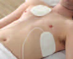 Chapter 9 Defibrillation presence of poor technique may rise to 150 ohm, reducing the current delivered and thereby decreasing the chance of successful defibrillation.
