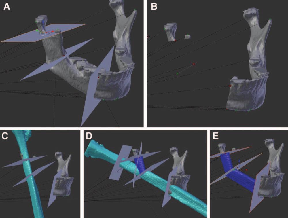 Numajiri et al. Low-cost CAD/CAM Cutting Guides Fig. 2. Virtual mandibular osteotomy and fibula inset. A, Two osteotomy planes are set near the condyle and right mental tubercle.