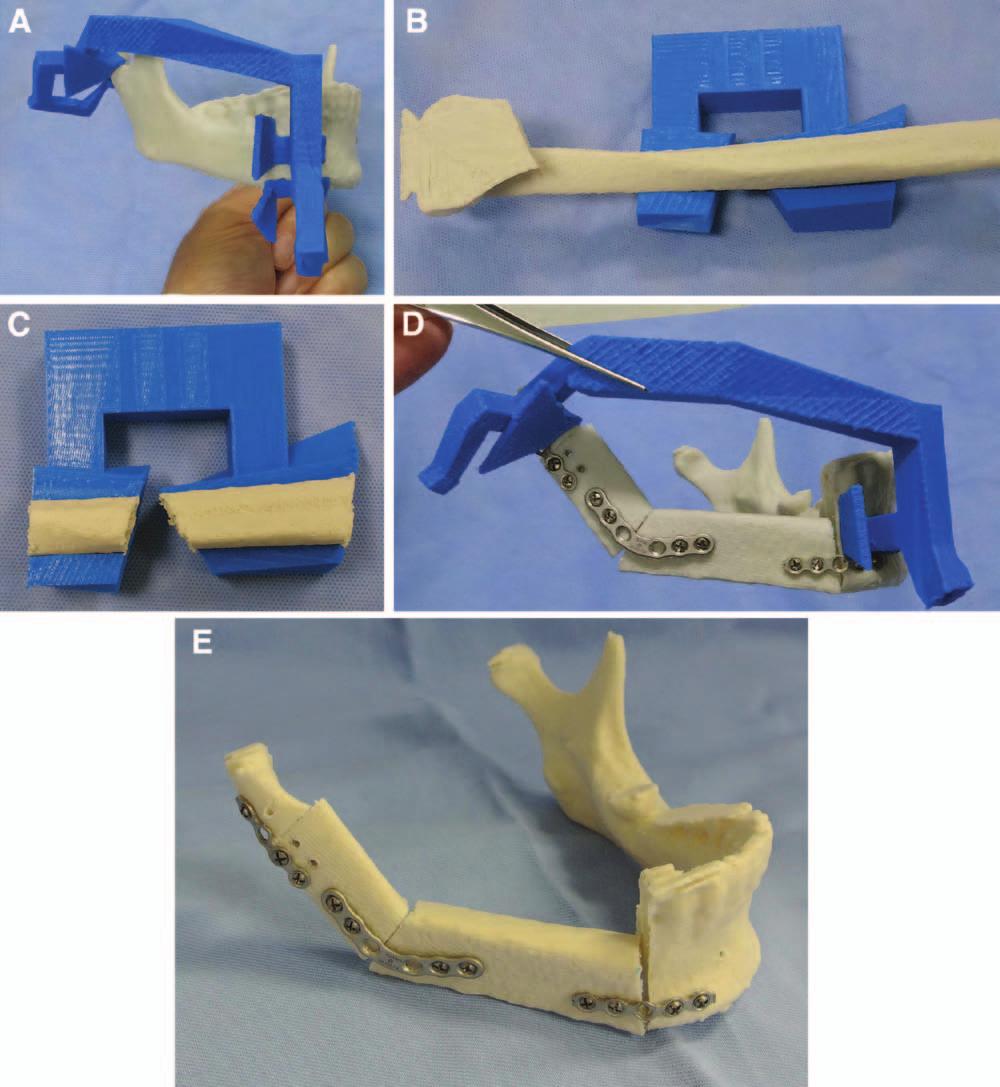 Numajiri et al. Low-cost CAD/CAM Cutting Guides Fig. 6. Model surgery. A, The printed mandibular cutting guide is fitted to the mandibular model. B, The fibular guide is placed in the fibular model.