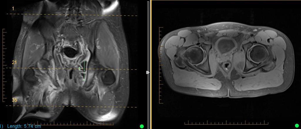 Osteomyelitis MRI: Pelvic
