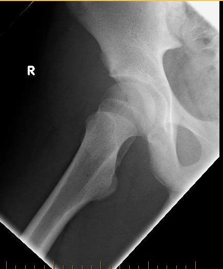 moderate right hip