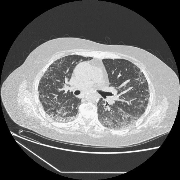 It can be argued that Case 1 could have started out with the pathology of superimposed DAD as the VATS lung biopsy was done quite late in the course of his exacerbation.
