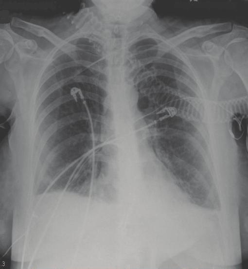 Case Reports in Infectious Diseases 3 (a) (b) Figure 2: Posteroanterior lung radiograph of the mother described in Case 1 on the day of delivery (a) and computed tomography of the thorax on the day