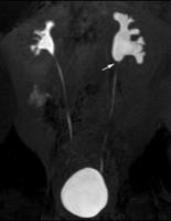 20-year-old man with ureteropelvic junction narrowing (arrow).