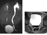 Figure 5. A 55-year-old man with left-sided ureteral stone.