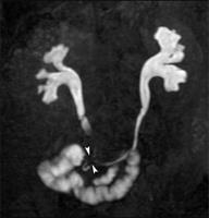 56-year-old woman with ileal loop urinary diversion.