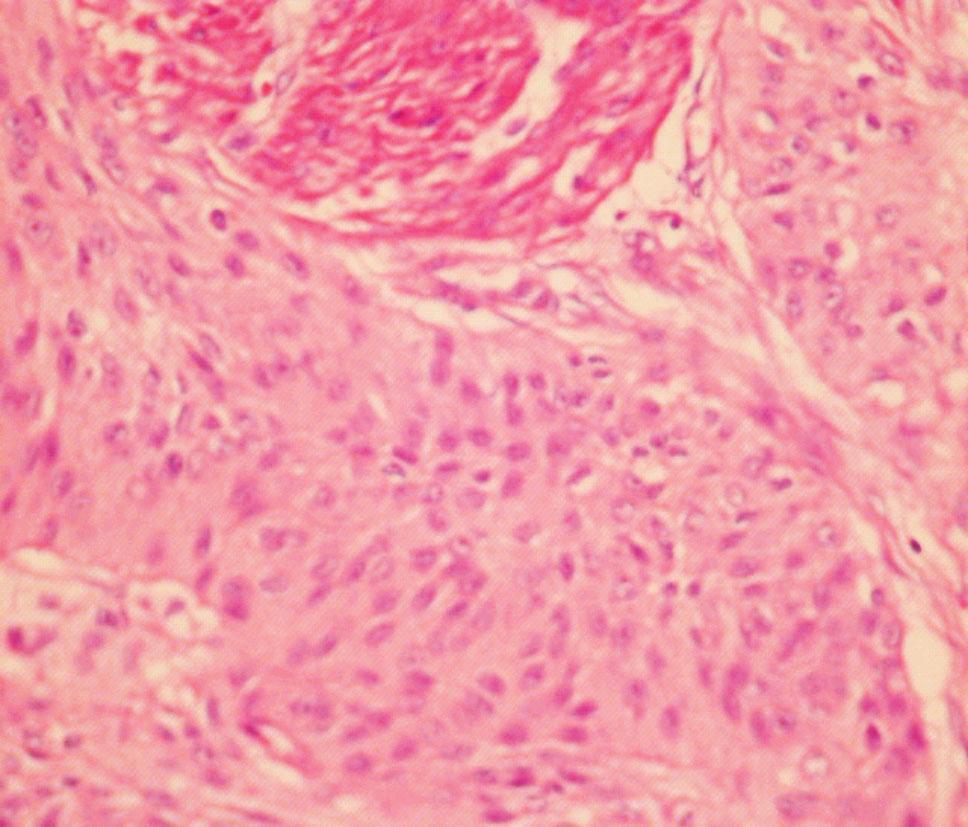 tumors 177 Figure 1 Urothelial bladder carcinoma