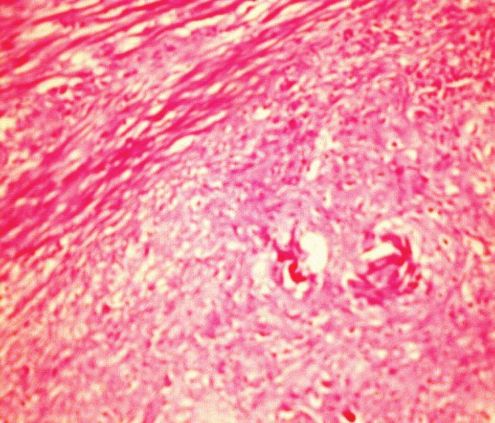20) Figure 2 Urothelial bladder carcinoma G2;