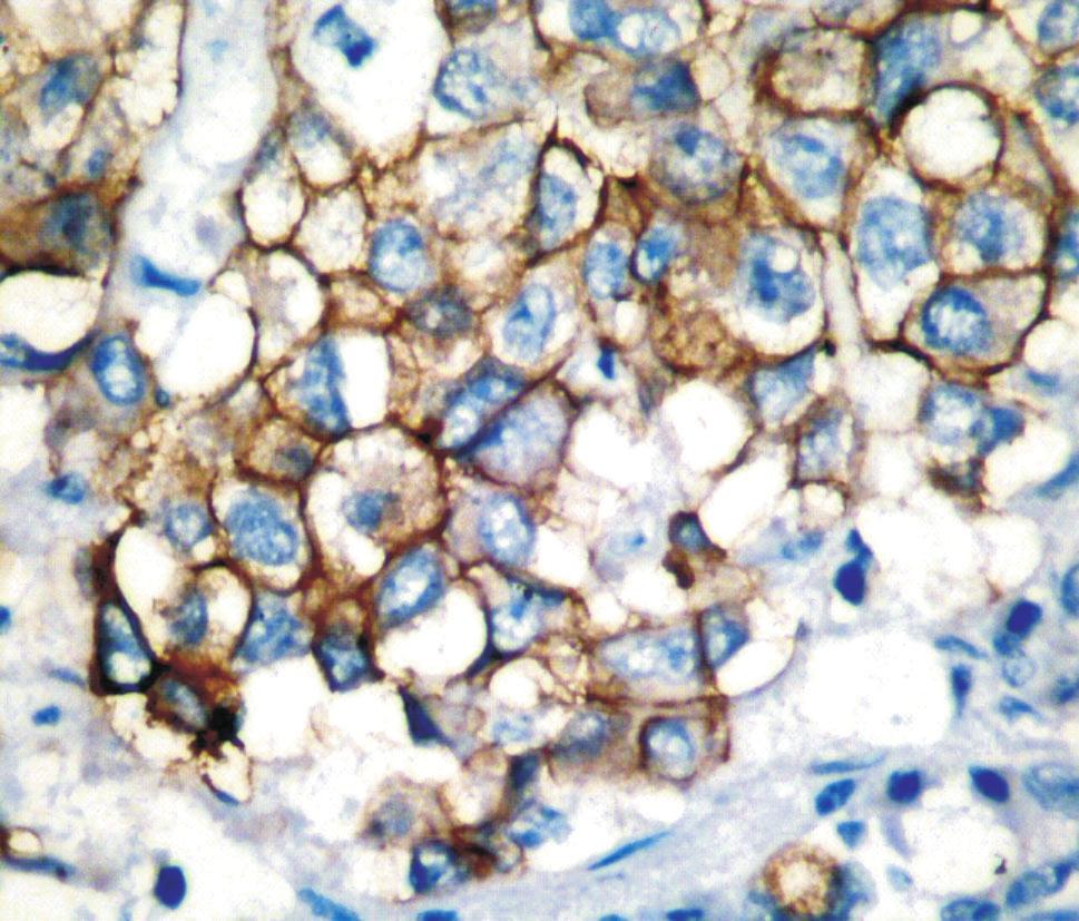 20) Figure 3 Urothelial bladder carcinoma with