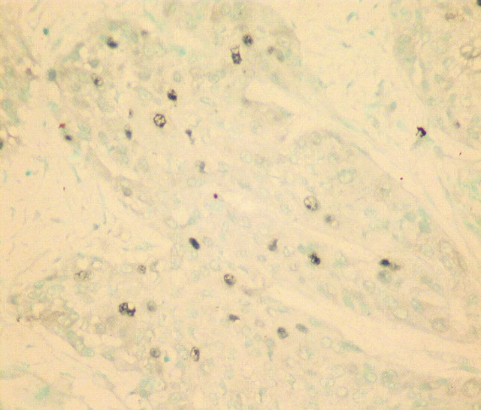 40) Figure 5  Positive zonal reaction (IHC stain