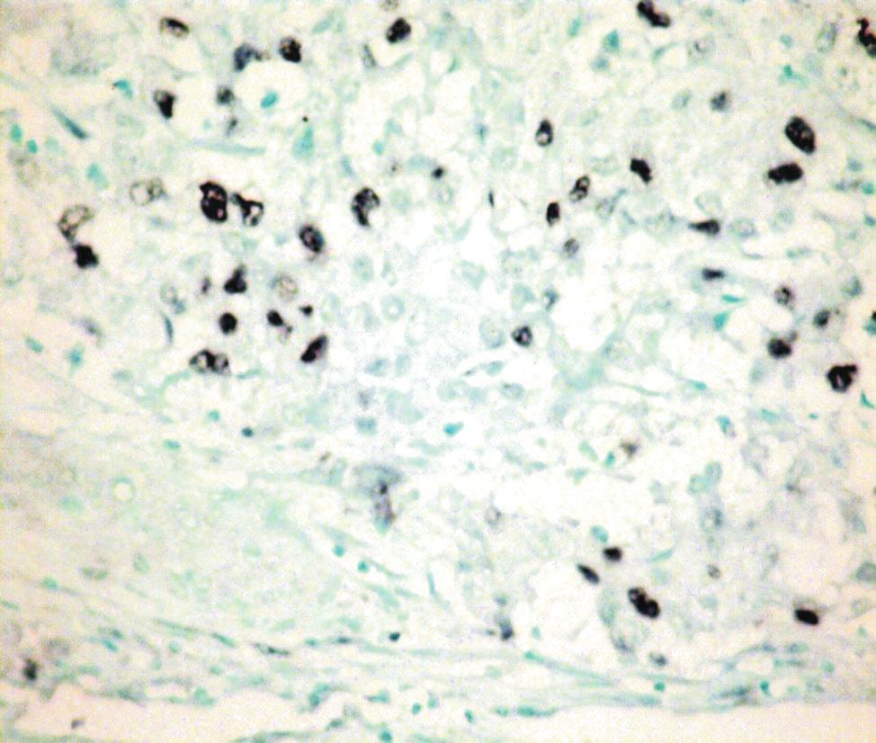 178 E. Traşcă et al. Figure 7 Urothelial carcinoma. Positive reaction in 2 (IHC stain for Ki67, ob.