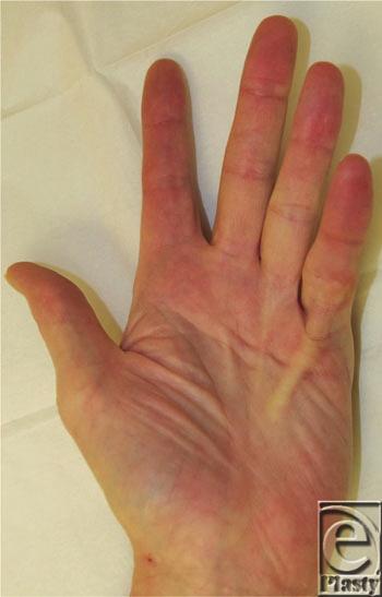Interesting Case Series Dupuytren s Contracture Aditya Sood, MD, Angie Paik, BA, and Edward Lee, MD Division of Plastic Surgery, University of Medicine and Dentistry of New Jersey, Newark, NJ