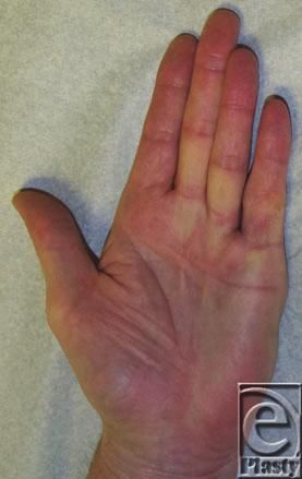 operation, patient displayed 5 of flexion contracture in left fifth MP joint, excellent range of