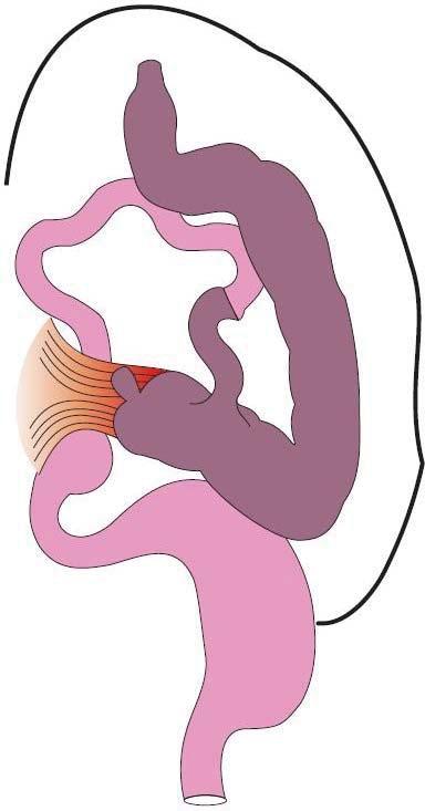 Congenital duodenal atresia can be complete or partial and intrinsic or extrinsic.