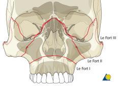 fracture Maxillary