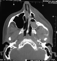 Zygomatic-Orbital Maxillary Fractures: 3 Point Approach ZMC fracture vertical and transverse