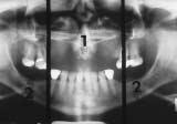 Implant Prosthodontic Management of Anterior Partial Edentulism: Long-Term Follow-Up Figure 1: Panoramic view of a partially edentulous patient illustrates the demarcation between anterior and