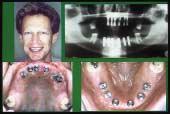 Implant Prosthodontic Management of Anterior Partial Edentulism: Long-Term Follow-Up Figure 4a: Experience with traditional implant placement in anterior edentulous zones provided an evolving