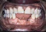 Figure 5a: Mandibular Class IV partial edentulism, with obvious deficits in tooth and bone support.