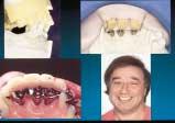 Prosthetic changes related to tooth wear were evaluated visually at annual clinical recall appointments.