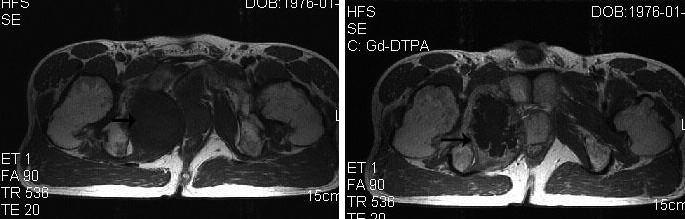 , Soft tissue mass on the right pubis (fine arrow), punctate calcification was observed in the mass (coarse arrow). The diagnosis of exostotic chondrosarcoma was confirmed by histopathology.