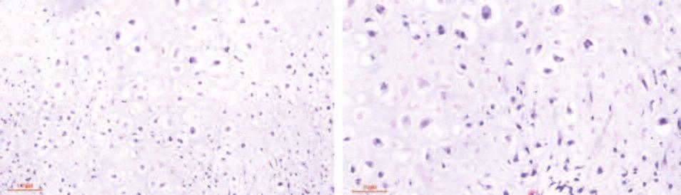 Morphological classification for prediction of malignant transformation in multiple exostoses Figure 5. HE staining.