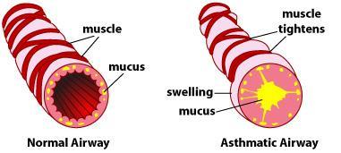 Asthma affects the airways: the tubes that carry air in and out of the lungs Airways become inflamed/swollen Muscles tighten around