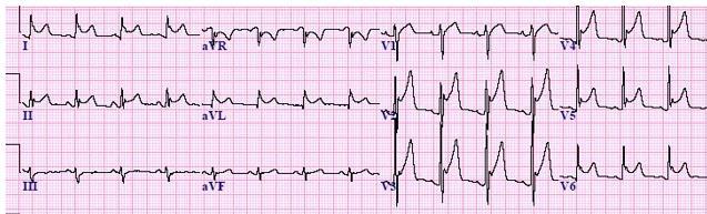 Patient experiences STEMI 3 days ago. Now with sharp chest pain relieved while leaning forward.