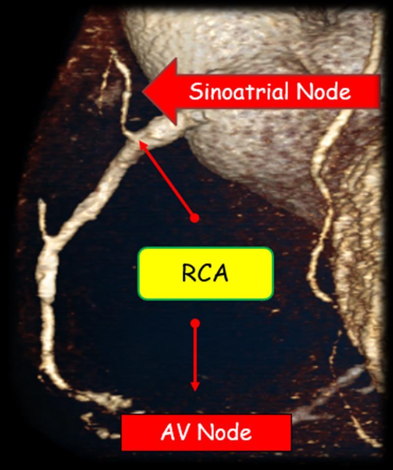 RCA occlusion (IMI) Bradyarrhythmias