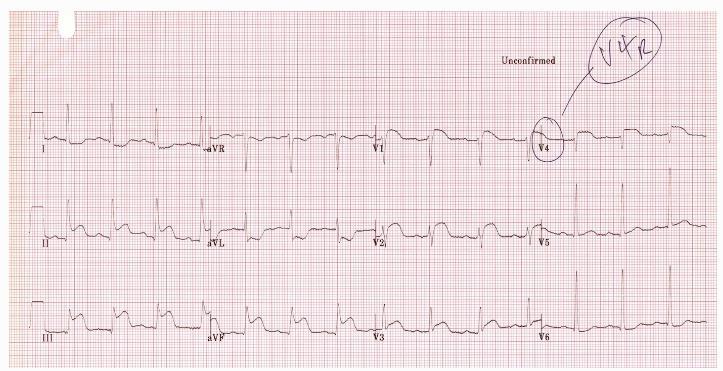 RCA RV infarct Hypotension Elevated