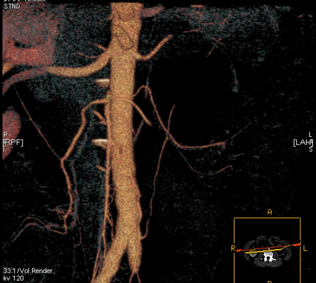 Fig. 0: Two accessory arteries in LT kidney UPJO, the inferior