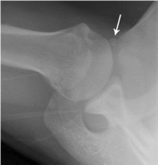 glenoid Bone loss usually occurs along a line parallel to the long axis of glenoid Glenoid Bone Deficiency Glenoid Bone Deficiency % of bone loss < > Recurrent dislocation?