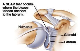 Labrum Anterior-Posterior tear Forceful traction (+/-